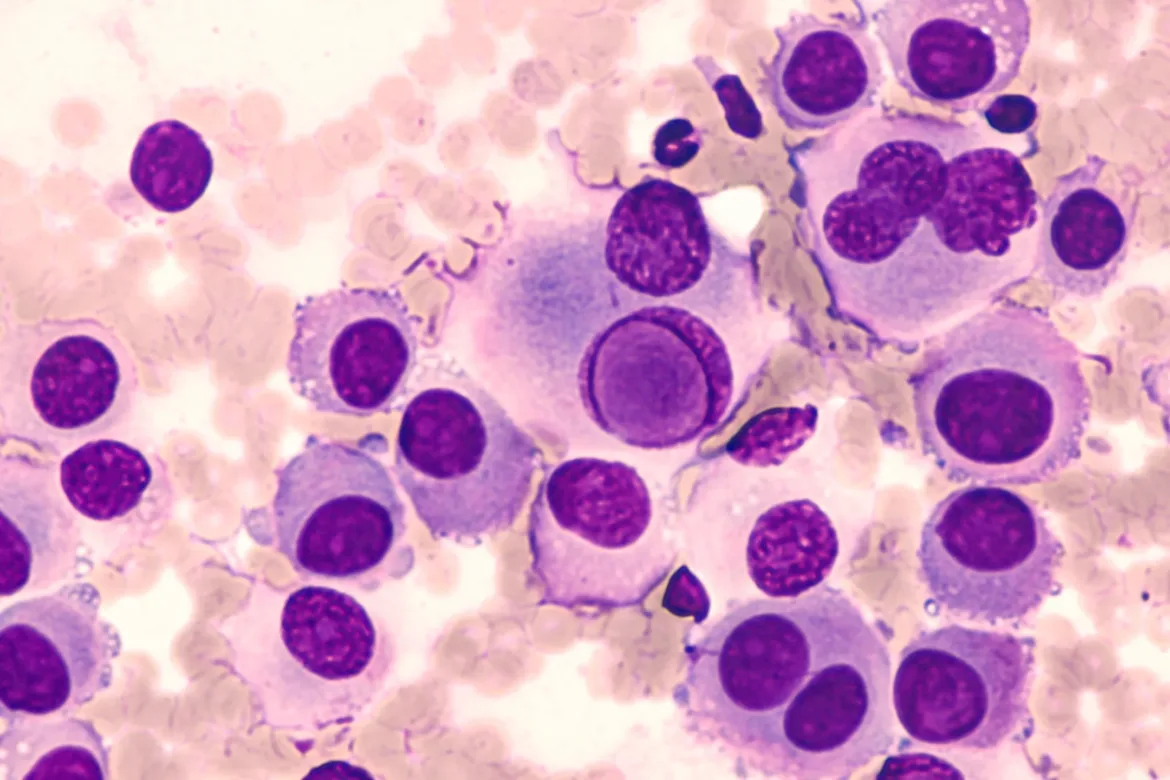 Cytologia aspiracyjna cienkoigłowa przerzutowego czerniaka