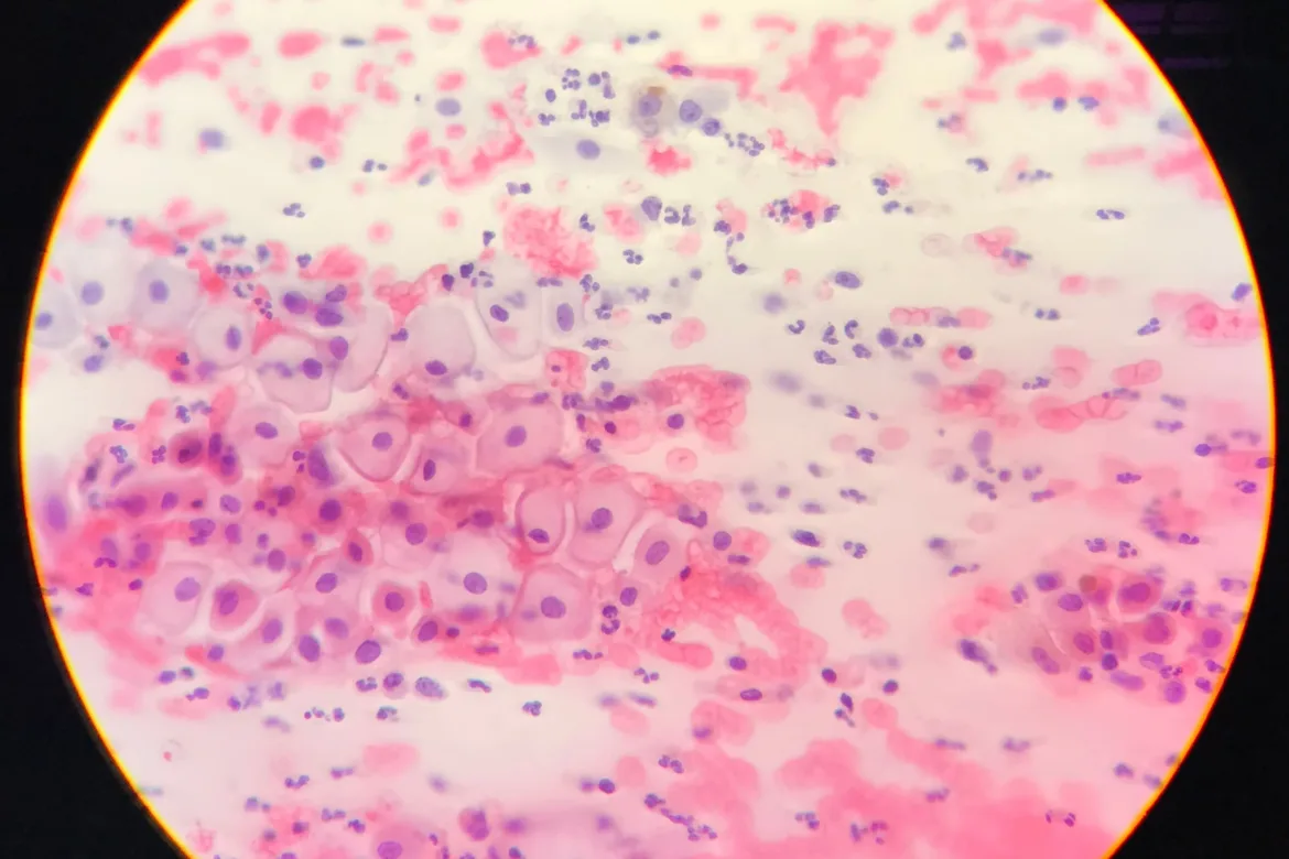 LSIL CIN1 - wymaz z cytologii