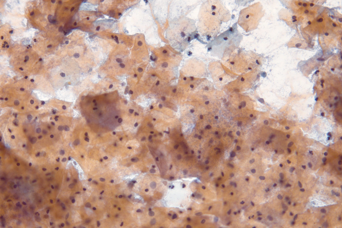 Mikroskopowy obraz infekcji bakteryjnej Gardnerella vaginalis