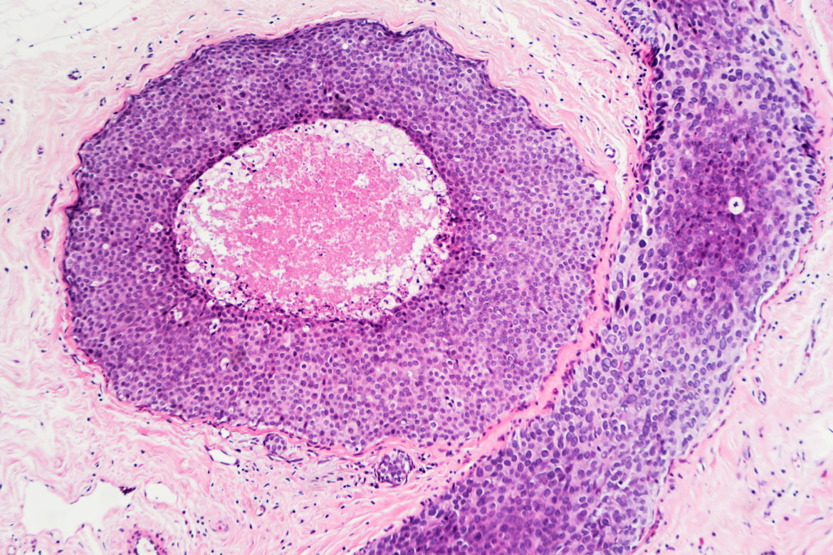 Rak piersi rak przewodowy in situ